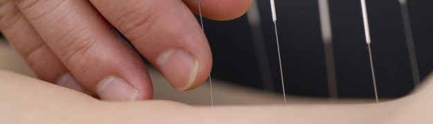 acupuncture.2476c1025b917e130ee5f20eaf777d69322