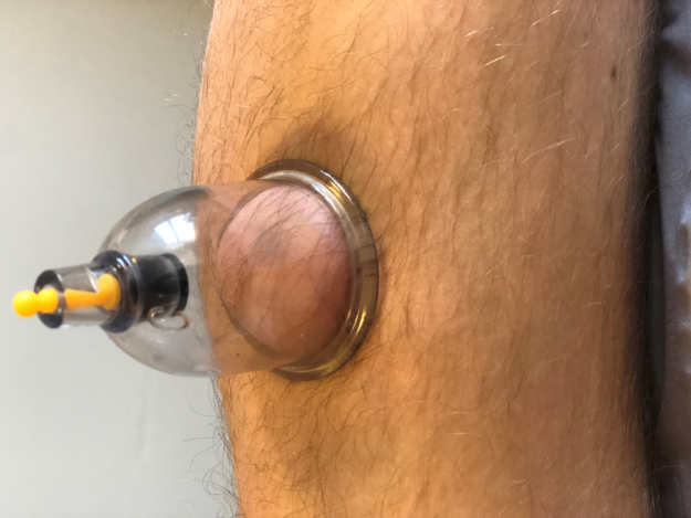 Cupping-therapy-leicester